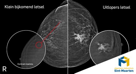 Schema van borstweefseltypen op mammografie (vet vs. klierweefsel)
