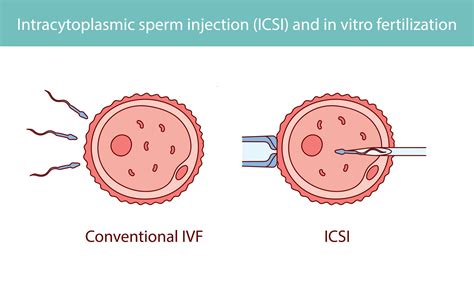 Infographic die de stappen van IVF en ICSI uitlegt, met visuele elementen van laboratoriumwerk en embryo's.