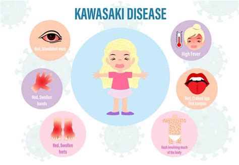 Illustratie van de symptomen van de ziekte van Kawasaki, met nadruk op rode ogen, frambozentong en huiduitslag.