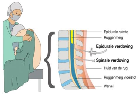 een vrouw die een epidurale verdoving krijgt met een mobiele monitor