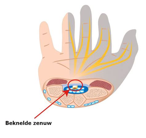 Schematische weergave van de carpale tunnel en de beknelde zenuw