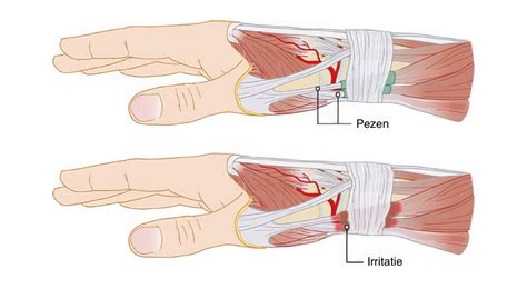 Illustratie van de pols met de pezen die betrokken zijn bij De Quervain's tenosynovitis