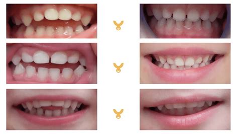 Diagram dat de impact van fopspeengebruik op de kaak en tanden illustreert