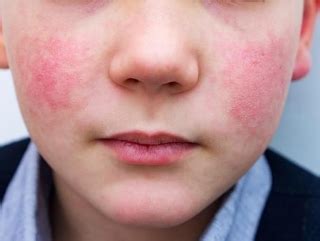 Illustratie van rode vlekjes op de wangen van een kind, kenmerkend voor de vijfde ziekte.