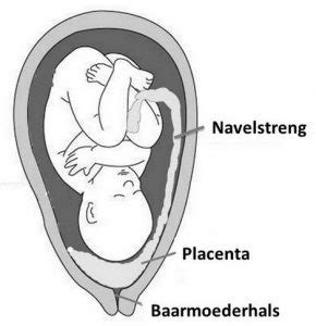 Illustratie van de verschillende posities van een voorliggende placenta (placenta praevia).
