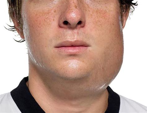 Illustratie van een kind met gezwollen wangen door bof