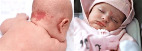 Collage van verschillende soorten geboortevlekken bij baby's, zoals ooievaarsbeet, mongolenvlek en café-au-lait-vlek.