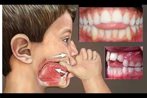 illustratie van de tongpositie bij slissen, met de tong tussen de tanden