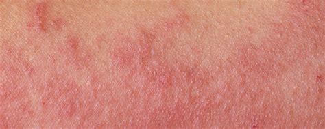 Gedetailleerde afbeelding van babybillen met luieruitslag en een afbeelding van hoe deze behandeld kan worden