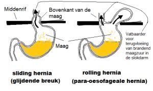 Illustratie van een sliding hernia en een para-oesofageale hernia