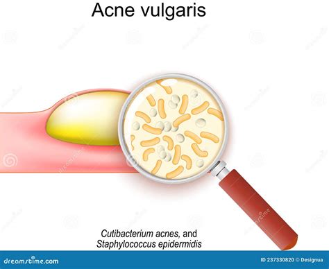 Illustratie van de huid met verstopte poriën en bacteriën die acne veroorzaken