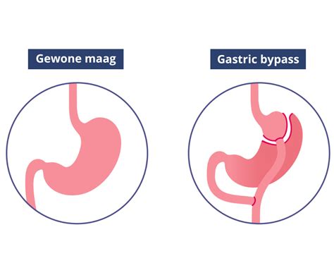 Charlotte Muis na haar gastric bypass, met een zichtbaar verschil in gewicht