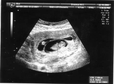 Schematische weergave van de CRL-meting op een echo rond 10 weken zwangerschap.