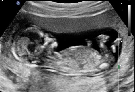 Voorbeeld van een echo rond 20 weken, waarop verschillende organen van de baby zichtbaar zijn.