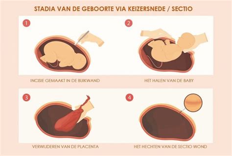 Schema van een keizersnede
