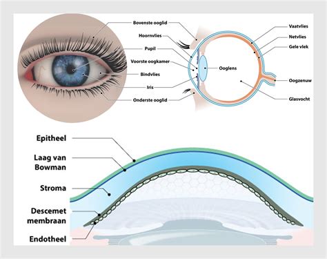 diagram dat de normale vorm van het hoornvlies toont, en hoe deze vervormd kan raken door wrijven