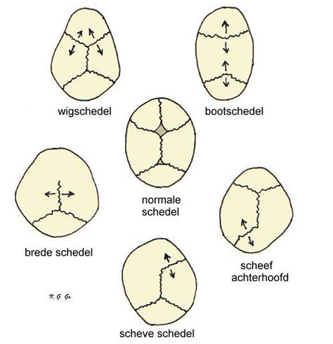 Schematische weergave van verschillende schedelvormen veroorzaakt door craniosynostose, naast een normale schedelvorm.