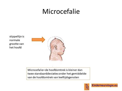 Infographic die de verschillende oorzaken van microcefalie categoriseert: genetisch, infecties, blootstelling aan toxines, zuurstoftekort.