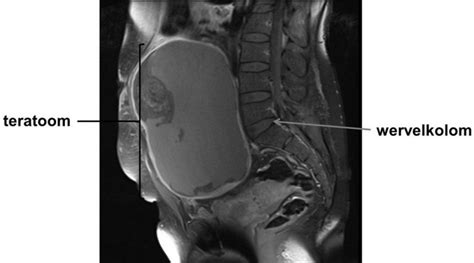 Illustratie van een teratoom met verschillende weefselcomponenten