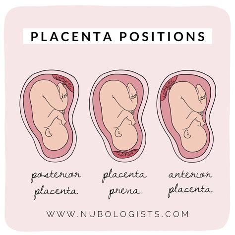 Illustratie van de baarmoeder met de placenta op verschillende posities (posterior, fundal, anterior)