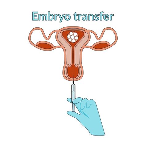 Illustratie van de embryotransfer procedure