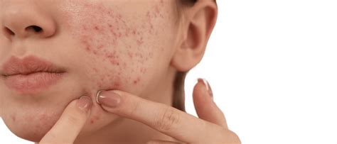 Illustratie van een zwangere vrouw met puistjes op het gezicht