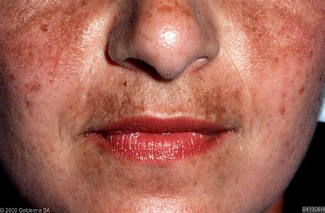 Voorbeelden van melasma op het gezicht