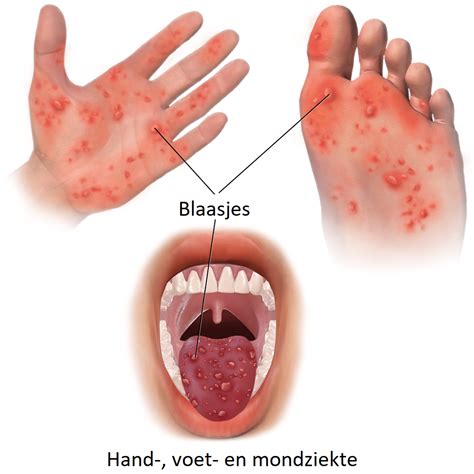 Illustratie van de typische blaasjes en zweertjes op handen, voeten en in de mond bij hand-, voet- en mondziekte.
