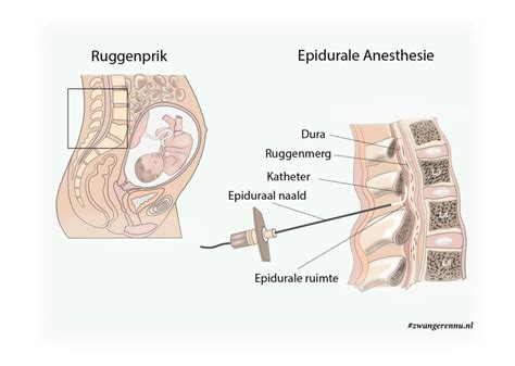 Illustratie van een ruggenprik procedure
