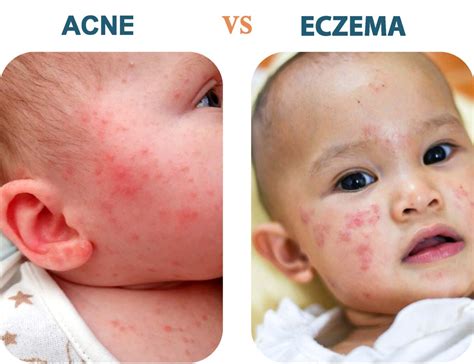 Illustratie van een baby met typische baby acne op de wangen.