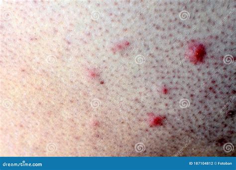 Close-up foto van baby acne, met nadruk op de textuur van de bultjes.