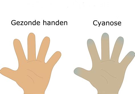 Een baby met cyanose (blauwe verkleuring) door zuurstofgebrek