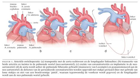 Schema van de arteriële switch operatie, waarbij de grote vaten worden omgewisseld