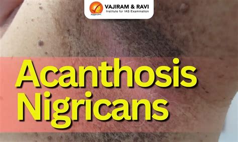 Illustratie van verschillende huidplooien waar Acanthosis Nigricans kan voorkomen.