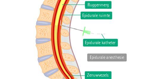Schematische weergave van de plaatsing van een epidurale katheter