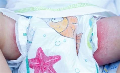 Illustratie van een babybil met luieruitslag, waarbij de rode geïrriteerde huid zichtbaar is.