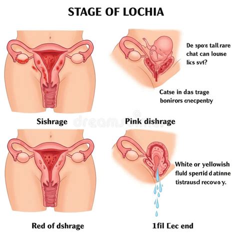 Illustratie van lochia: bloedverlies na de bevalling.