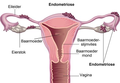 Illustratie van een baarmoeder met een slag (torsie).