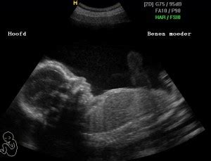 Vergelijking van een 2D echo (profiel) en een 3D echo (gezichtje).