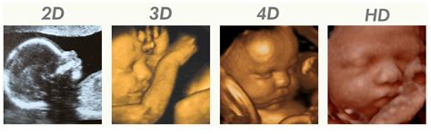 Collage van 2D, 3D en 4D echo beelden van baby's