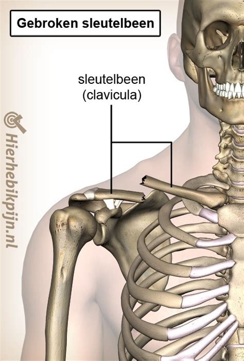 Illustratie van de anatomie van het sleutelbeen en de locatie van veelvoorkomende breuken (Type 1, 2, 3)