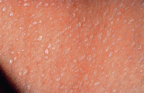 Close-up foto van babyhuid met warmte-uitslag