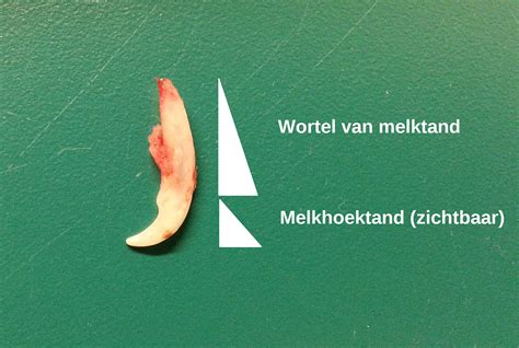 Illustratie van een melktand met glazuurafwijking.
