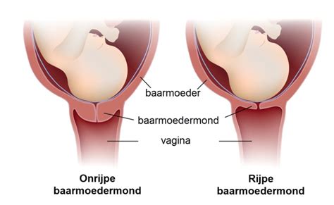 Vergelijkingstekening van een rijpe en onrijpe baarmoedermond