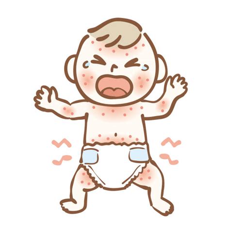 Illustratie van een baby met verschillende soorten huiduitslag
