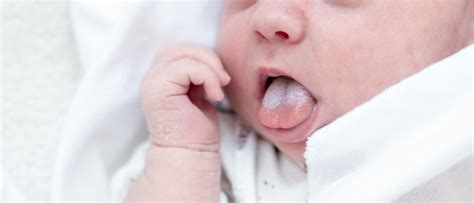 Illustratie van witte vlekjes in de mond van een baby, kenmerkend voor spruw.