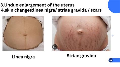 Verschillende typen buikveranderingen na de bevalling: slappe huid, striae, linea nigra en diastase.