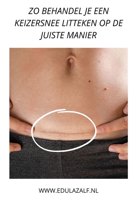 Illustratie van een keizersnede met een zichtbaar litteken.