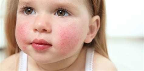 baby met rode en witte bultjes op de wangen en kin