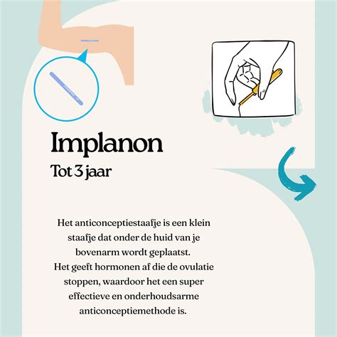 Schematische weergave van de plaatsing van de Implanon in de bovenarm.